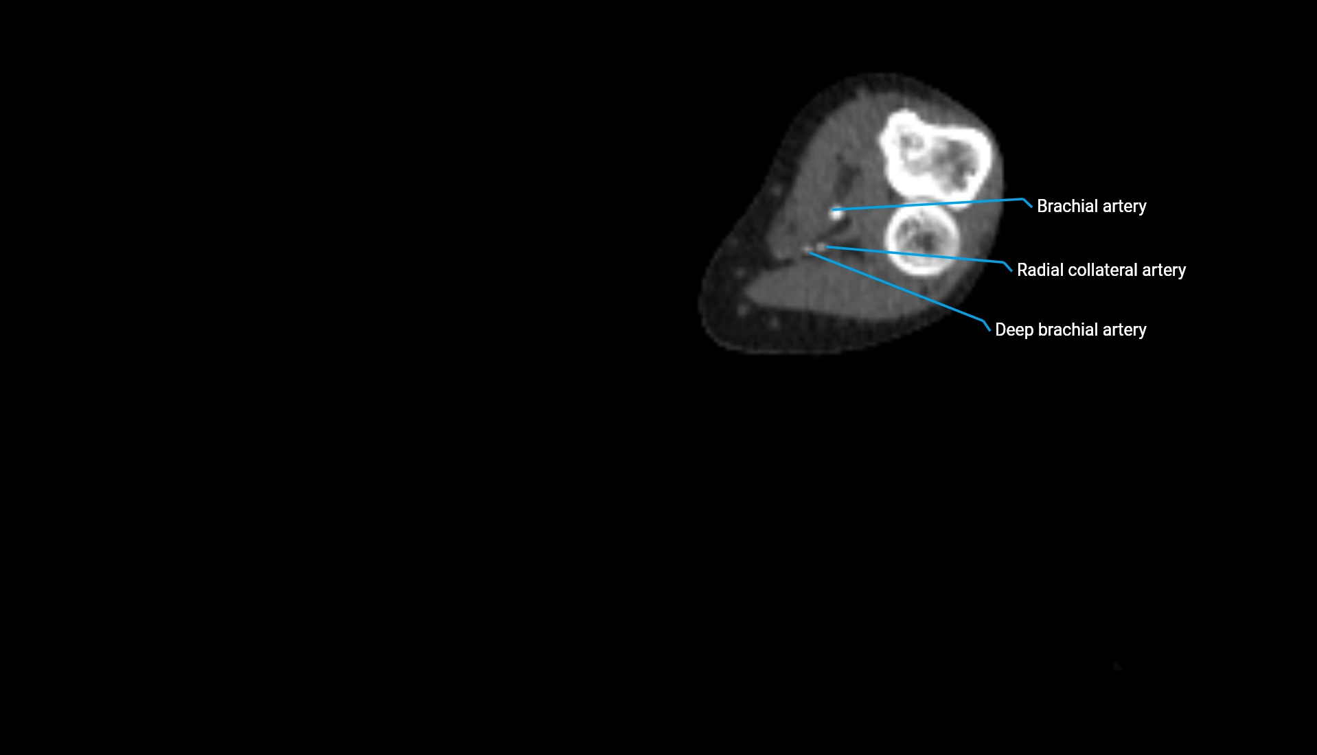 CTA upper limb axial cross sectional anatomy labelled image 181 (2).webp